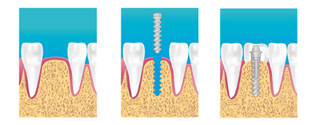 implant dentaire chalon sur saone implant dentaire chalon sur saone
